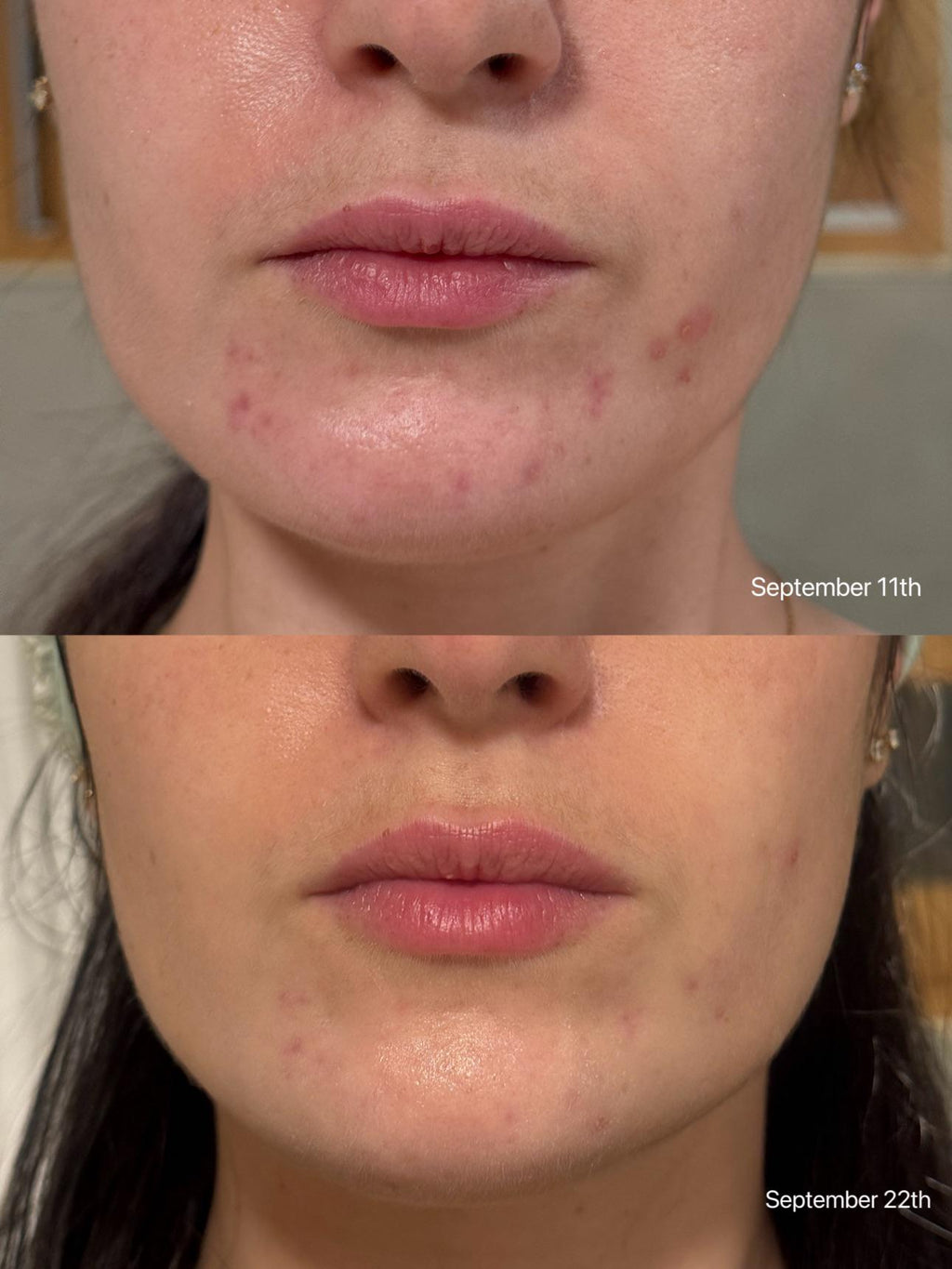 VT Cica Reedle Shot 300 SkinGlow