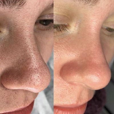 Anua Heartleaf LHA Gel gommant hydratant SkinGlow