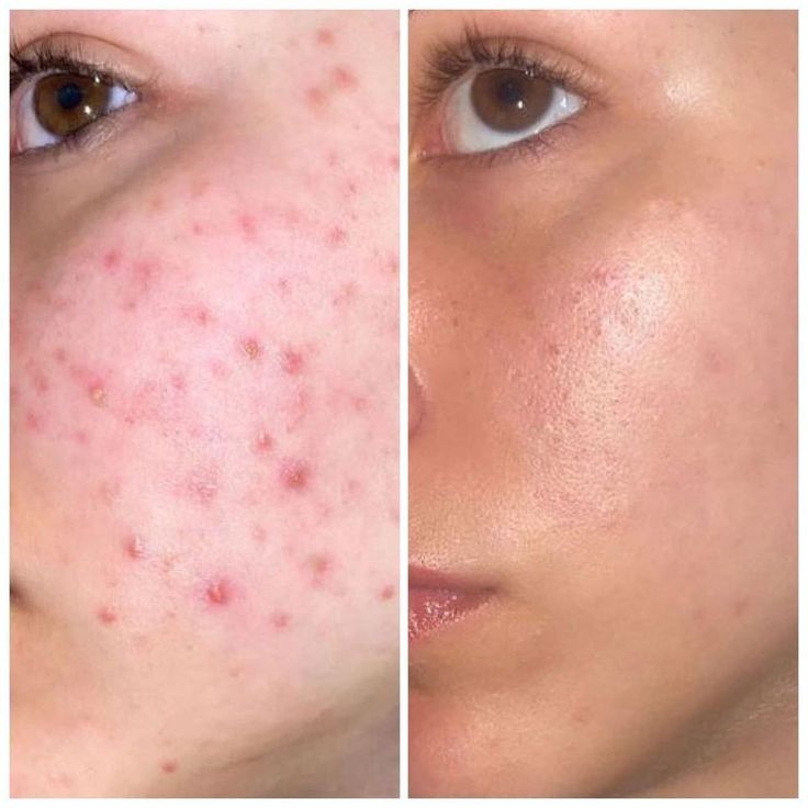 Medicube - Tonique apaisant Pdrn Pink Cica SkinGlow