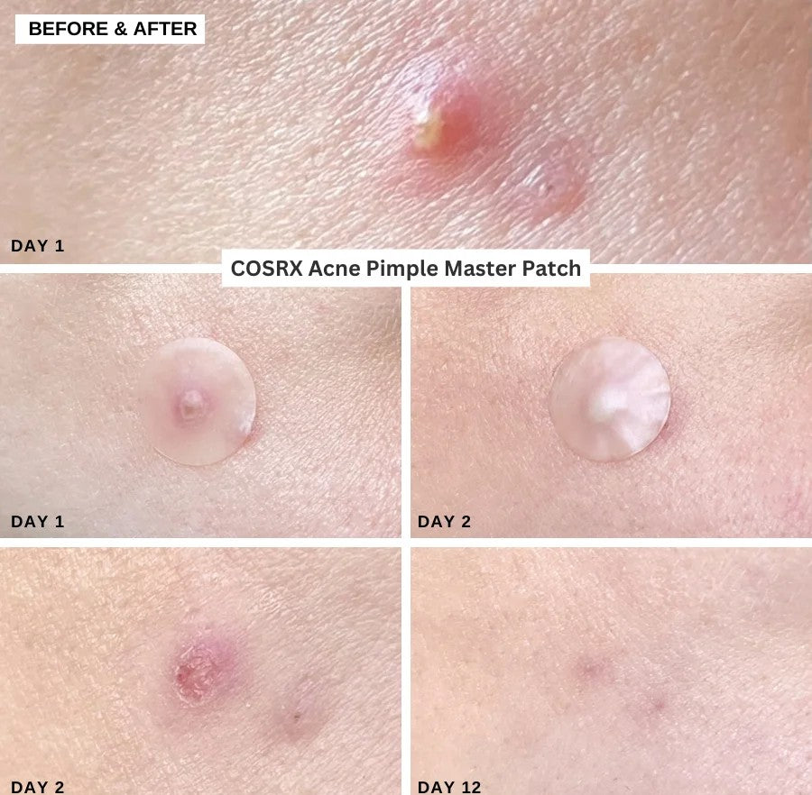 Cosrx Acne Pimple Master Patch SkinGlow