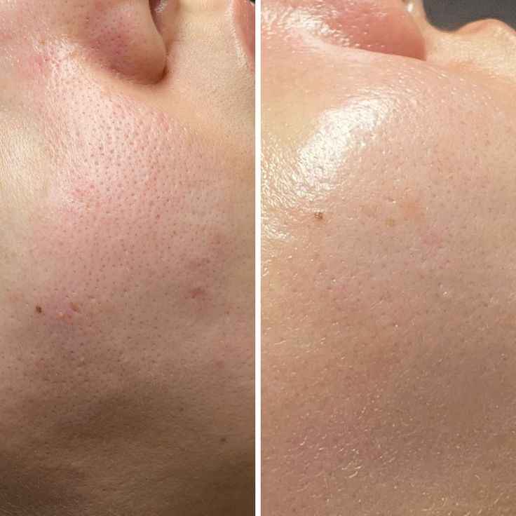 Dr Althea baume nettoyant exfoliant Pore Refresh