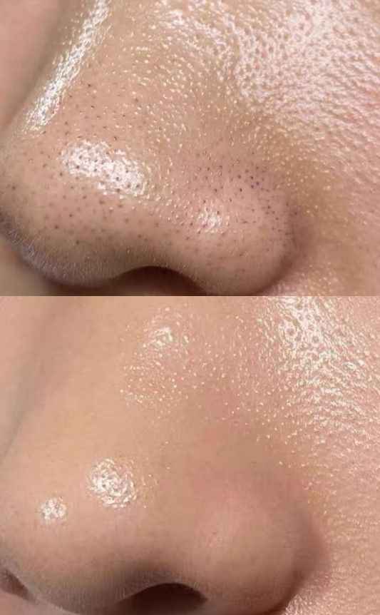 Medicube huile nettoyante en profondeur Zero Pore Blackhead SkinGlow